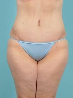 Tummy Tuck Before & After Image