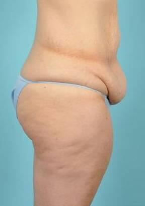 Tummy Tuck Before & After Image