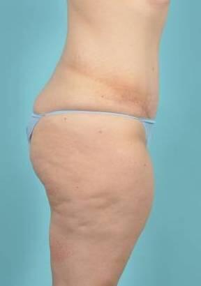 Tummy Tuck Before & After Image