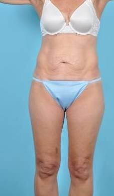 Tummy Tuck Before & After Image