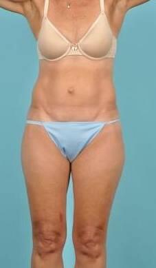 Tummy Tuck Before & After Image