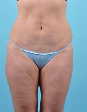 Tummy Tuck Before & After Image