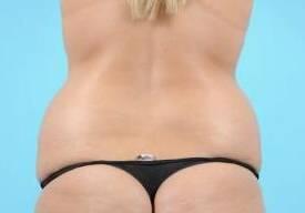 Tummy Tuck Before & After Image