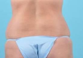 Tummy Tuck Before & After Image