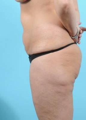 Tummy Tuck Before & After Image Patient 26638