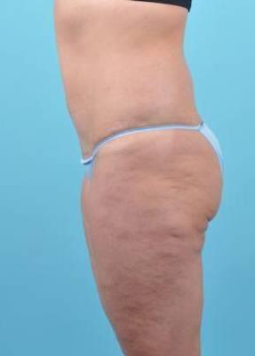Tummy Tuck Before & After Image Patient 26638