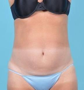 Tummy Tuck Before & After Image