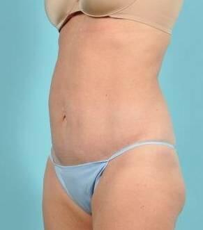 Tummy Tuck Before & After Image Patient 26639