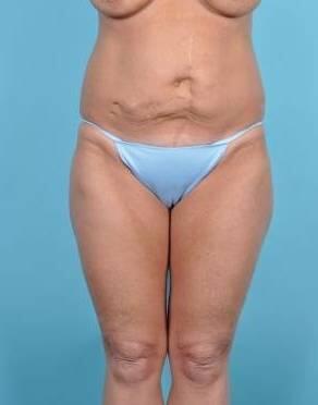 Tummy Tuck Before & After Image