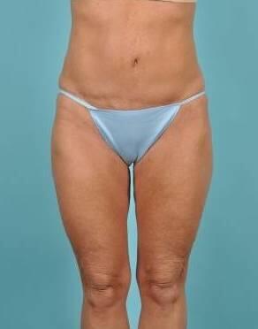 Tummy Tuck Before & After Image Patient 26640