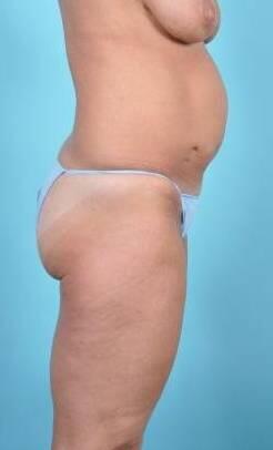 Tummy Tuck Before & After Image Patient 26640