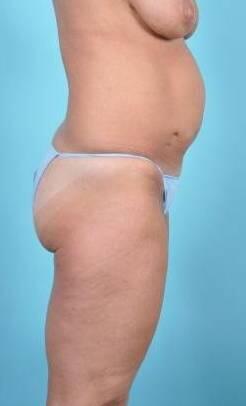 Tummy Tuck Before & After Image