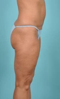 Tummy Tuck Before & After Image Patient 26640