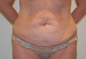 Tummy Tuck Before & After Image