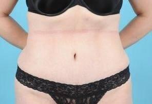 Tummy Tuck Before & After Image Patient 26641