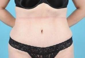 Tummy Tuck Before & After Image