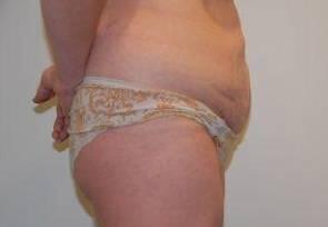 Tummy Tuck Before & After Image