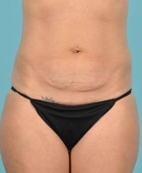 Tummy Tuck Before & After Image