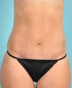 Tummy Tuck Before & After Image