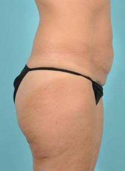 Tummy Tuck Before & After Image Patient 26642