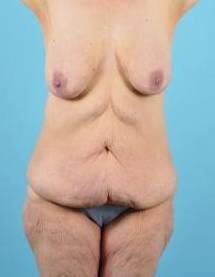 Tummy Tuck Before & After Image