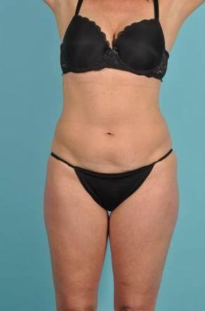 Tummy Tuck Before & After Image