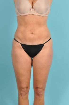 Tummy Tuck Before & After Image