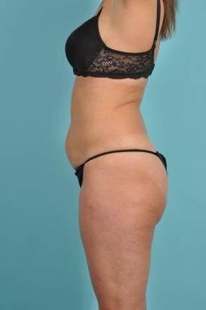 Tummy Tuck Before & After Image Patient 26644