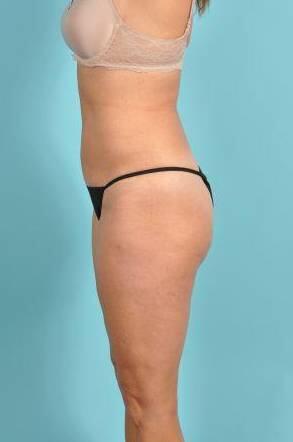 Tummy Tuck Before & After Image Patient 26644