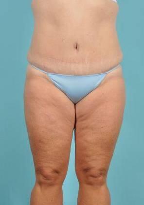 Tummy Tuck Before & After Image