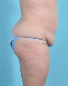 Tummy Tuck Before & After Image