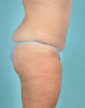 Tummy Tuck Before & After Image Patient 26645