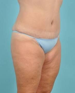 Tummy Tuck Before & After Image