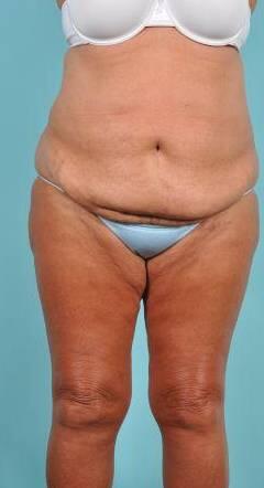 Tummy Tuck Before & After Image Patient 26646