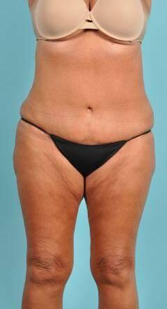 Tummy Tuck Before & After Image