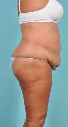 Tummy Tuck Before & After Image