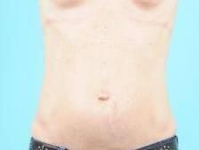 Tummy Tuck Before & After Image Patient 26647