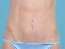 Tummy Tuck Before & After Image