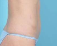 Tummy Tuck Before & After Image