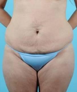 Tummy Tuck Before & After Image