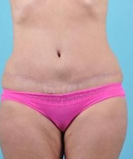 Tummy Tuck Before & After Image