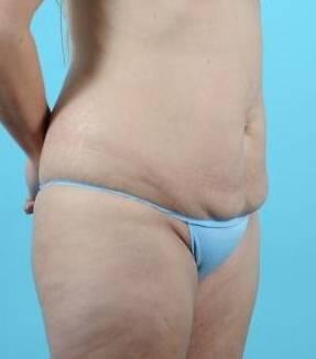 Tummy Tuck Before & After Image Patient 26648