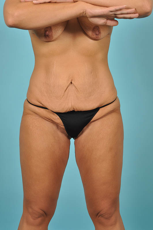 Tummy Tuck Before & After Image