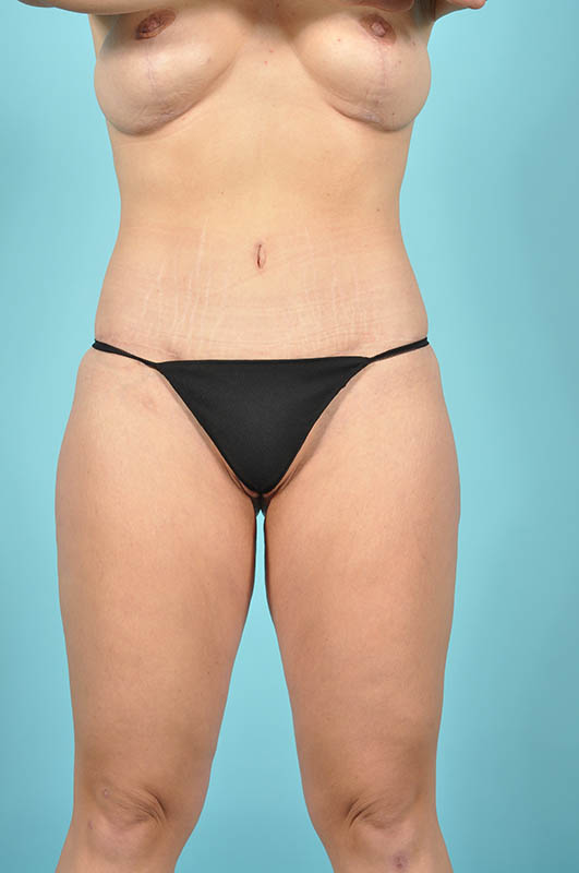 Tummy Tuck Before & After Image