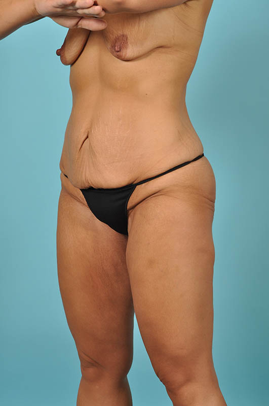 Tummy Tuck Before & After Image Patient 26649