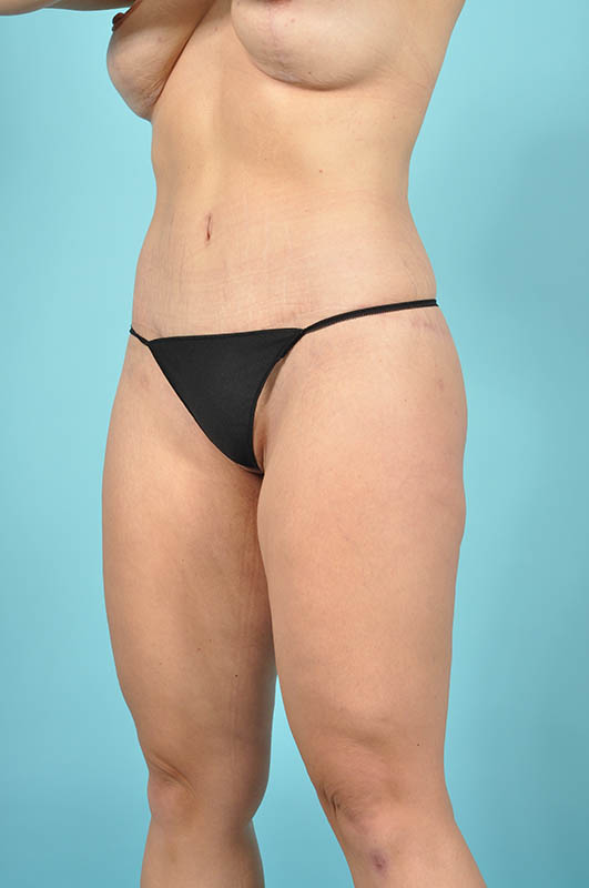 Tummy Tuck Before & After Image