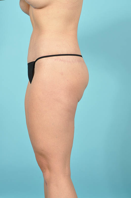 Tummy Tuck Before & After Image