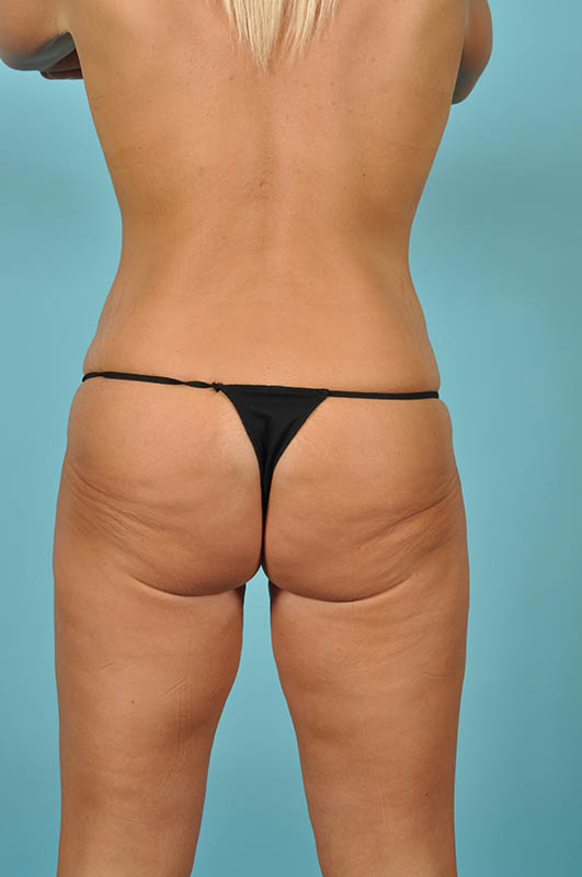 Tummy Tuck Before & After Image Patient 26649