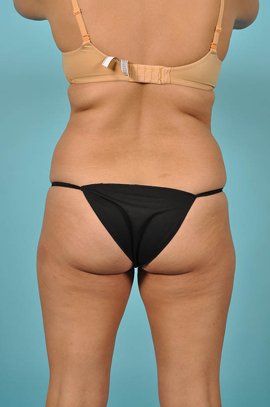 Tummy Tuck Before & After Image Patient 27433