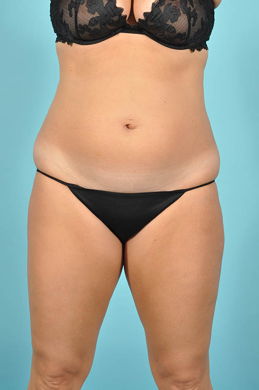 Tummy Tuck Before & After Image Patient 29118